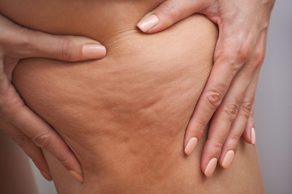 astuces naturelles pour combattre la cellulite
