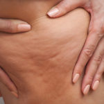 astuces naturelles pour combattre la cellulite